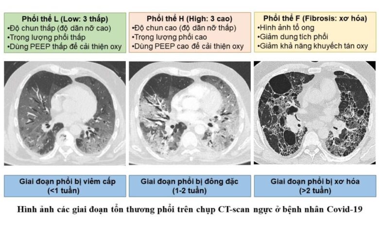 Tiếp cận chẩn đoán và điều trị xơ phổi cho người bệnh hậu Covid-19 ...