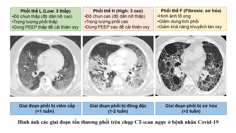 Tiếp cận chẩn đoán và điều trị xơ phổi cho người bệnh hậu Covid-19 ...